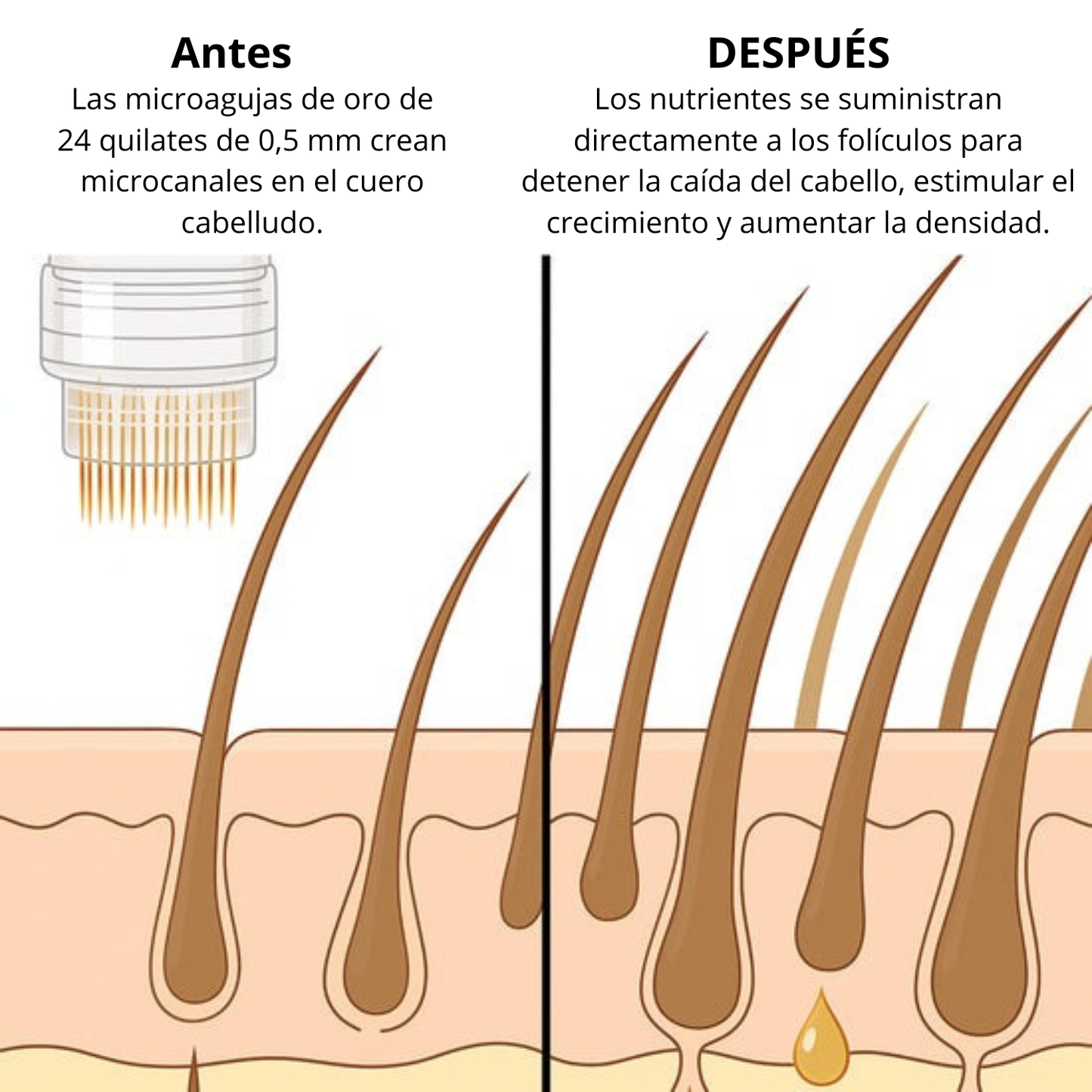 Tecnología Capilar MICRO-INFUSE® – Para Hombres