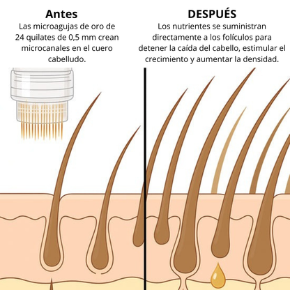 Tecnología Capilar MICRO-INFUSE® – Para Hombres