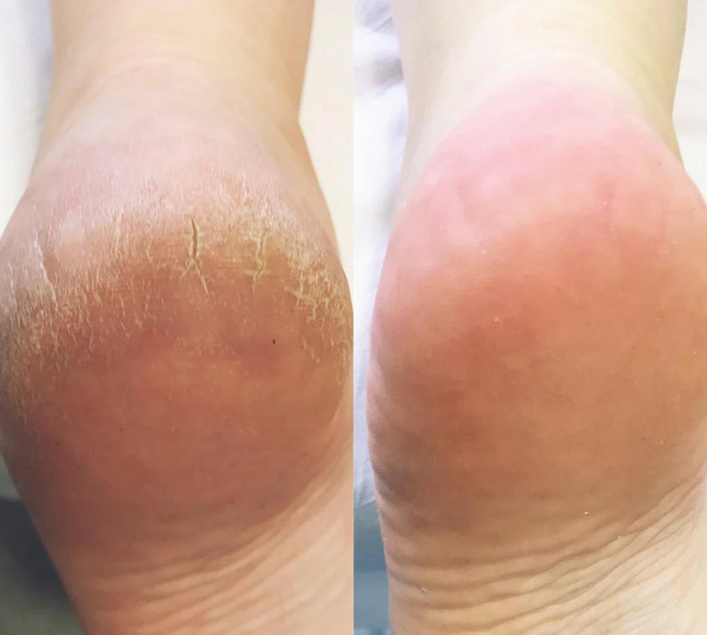 PediSoft™ | Removedor Eléctrico De Callos.