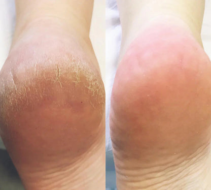 PediSoft™ | Removedor Eléctrico De Callos.