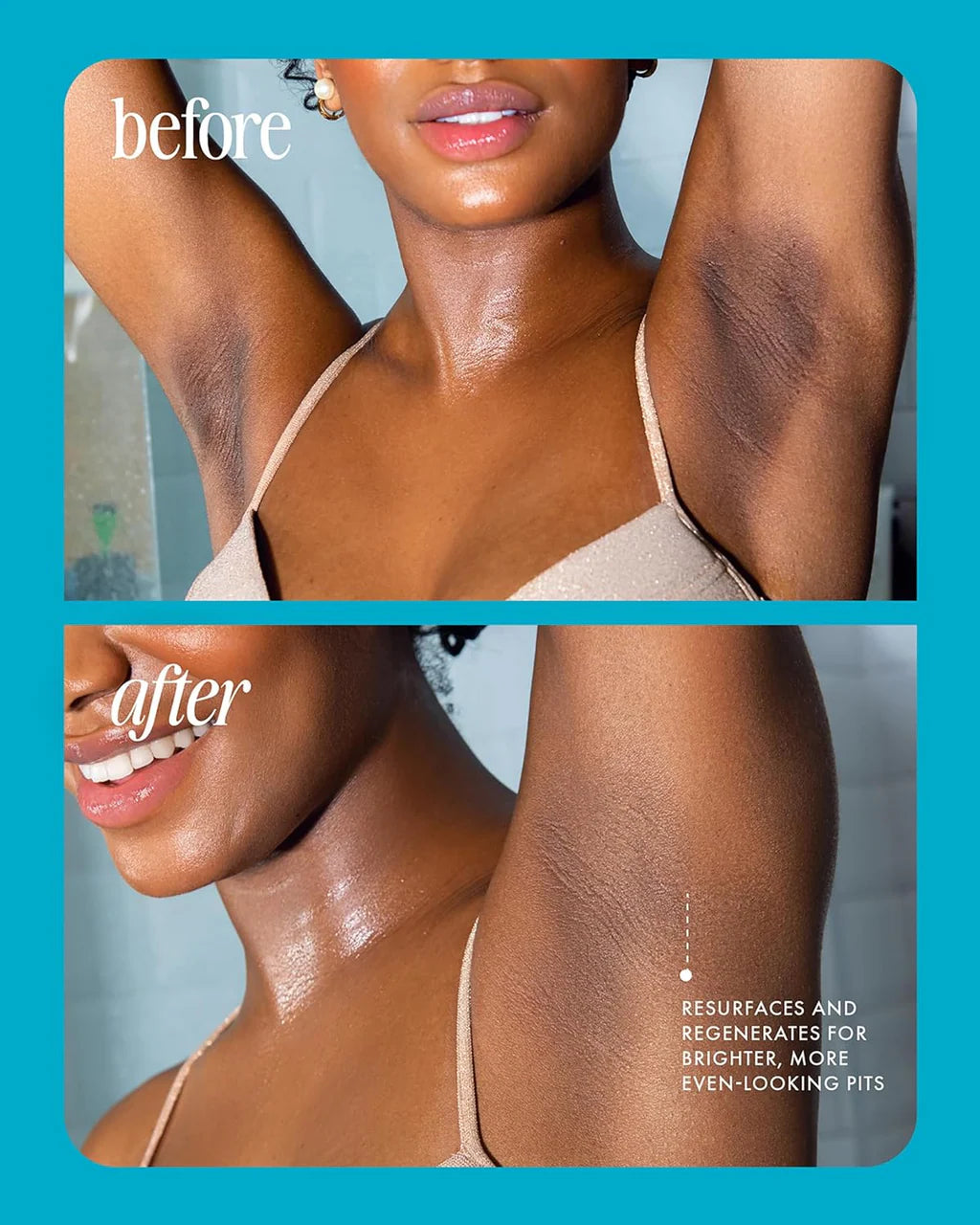 DermaPure™ | Adiós manchas, En la zona V