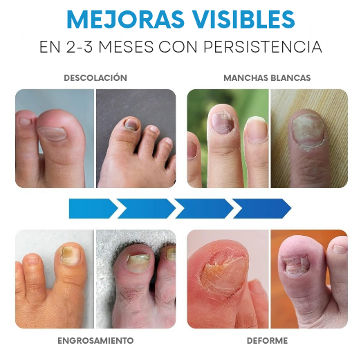 ClearStep™ | Terapia Láser Estética para Uñas Saludables