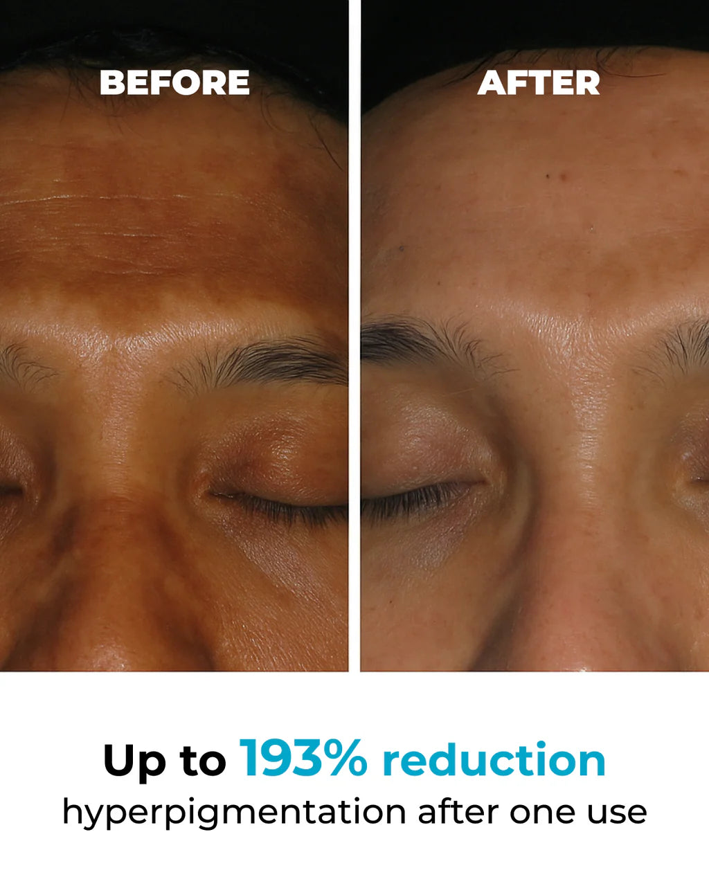 DermaPure™ | Adiós manchas, En la zona V