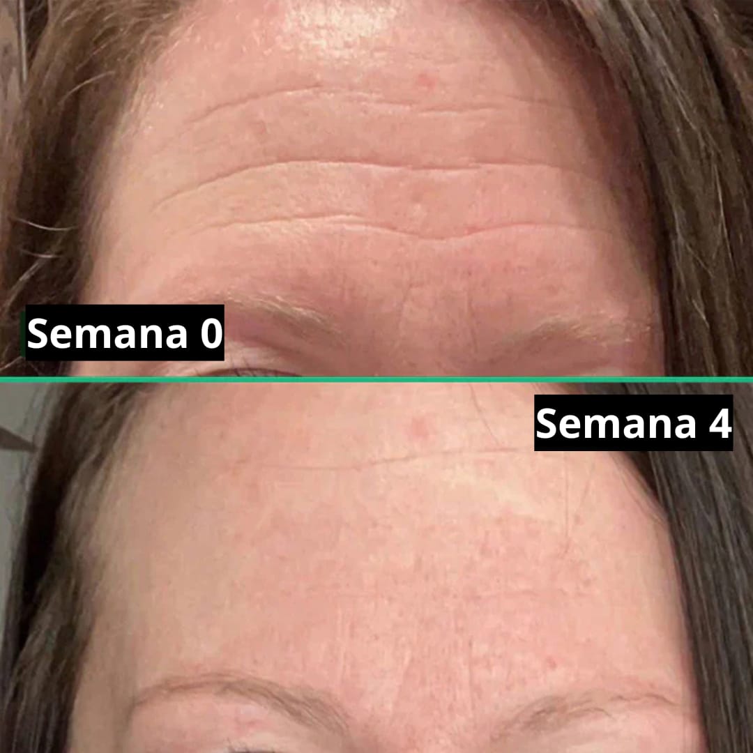 Cicatrix Vanish™ | Elimina Marcas De Acné, Cirugías y Quemaduras En 4 Semanas…!