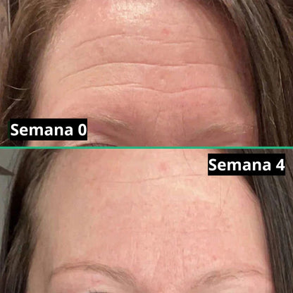 Cicatrix Vanish™ | Elimina Marcas De Acné, Cirugías y Quemaduras En 4 Semanas…!