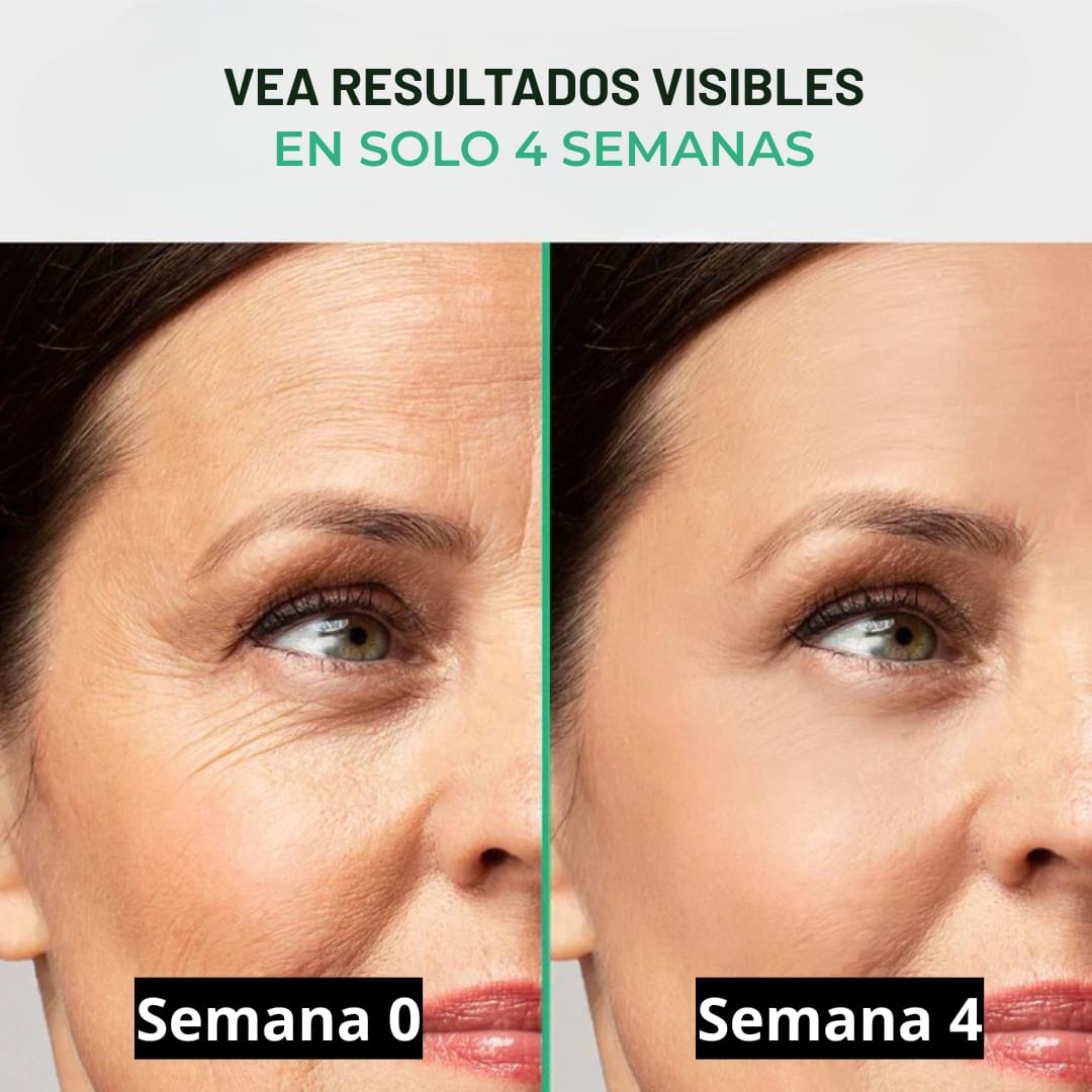 Cicatrix Vanish™ | Elimina Marcas De Acné, Cirugías y Quemaduras En 4 Semanas…!