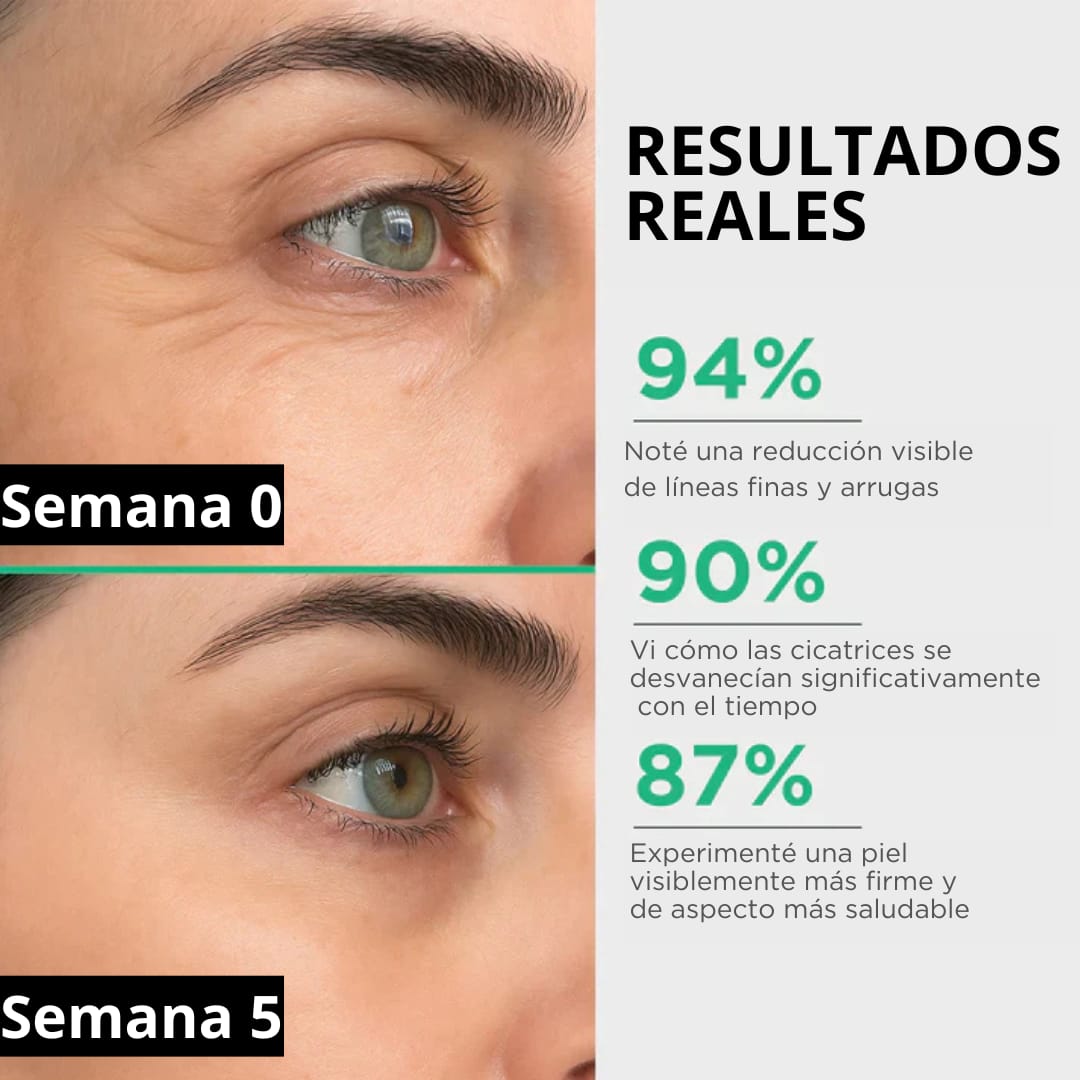 Cicatrix Vanish™ | Elimina Marcas De Acné, Cirugías y Quemaduras En 4 Semanas…!